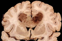 11 bệnh ung thư dễ bị di truyền từ người thân