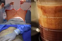 Rợn người xem cắt xẻo bụng mỡ bùng nhùng thành eo thon