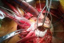 Cứu sống bệnh nhân vỡ tim cực hiếm ở Bắc Ninh