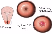 Hơn 12.000 người mắc ung thư cổ tử cung mỗi năm 