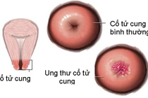 Hơn 12.000 người mắc ung thư cổ tử cung mỗi năm 