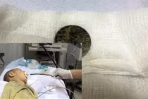 Pin mắc kẹt trong thực quản, bé 17 tháng tuổi suýt chết