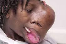 Xót xa những bệnh nhân có khối u khổng lồ trên mặt