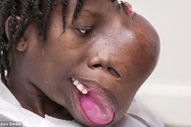 Xót xa những bệnh nhân có khối u khổng lồ trên mặt