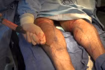 Rùng rợn phẫu thuật xẻo cơ bắp, cắt ngón chân làm đẹp 