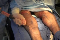 Rùng rợn phẫu thuật xẻo cơ bắp, cắt ngón chân làm đẹp 