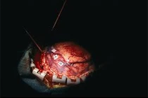 Cách phân biệt khối u lành tính và khối u ác tính 