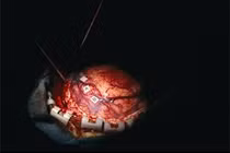 Cách phân biệt khối u lành tính và khối u ác tính 