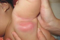 Những phản ứng khi tiêm vắc xin ở trẻ rất nên biết