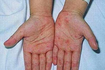 Dấu hiệu nhận biết sớm bệnh sốt xuất huyết