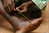 Sởn gai ốc trước những động vật ký sinh đáng sợ nhất 