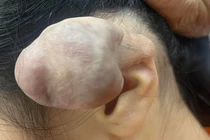 3 lần phẫu thuật u khủng vì bấm 6 lỗ tai cho “chất”
