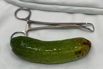 “Sửng sốt” với quả dưa leo trong hậu môn nam thanh niên thích cảm giác lạ