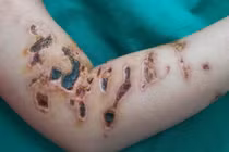 Khi tắm biển bị sứa đốt, tuyệt đối không làm điều này