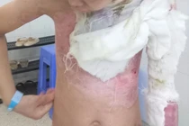 TP HCM: Liên tiếp hai trẻ nhỏ bị bỏng do cồn và xăng