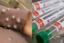 Virus đậu mùa khỉ đang tăng tốc biến hóa