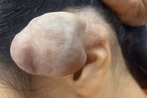 3 lần phẫu thuật u khủng vì bấm 6 lỗ tai cho “chất”