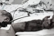 Mắc võng vào máy may, bé mới sinh bị máy ngã đè gãy xương cánh tay