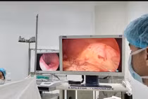 Điều trị ung thư thực quản bằng phẫu thuật nội soi hoàn toàn