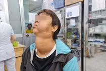 U lớn tuyến giáp kết hợp u máu đẩy khí quản và thực quản sang phải