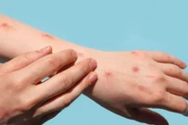 5 dấu hiệu nguy hiểm, chuyển nặng của bệnh đậu mùa khỉ 