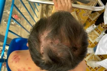 Lở loét toàn thân, rụng tóc vì bệnh Rowell hiếm gặp 