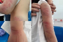 Bé gái ở Vĩnh Phúc bị bố đánh đập thâm tím người