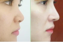 Nâng mũi 600.000 đồng, nữ sinh viên ở TP HCM có nguy cơ mù mắt