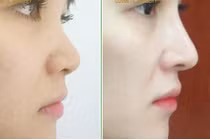 Nâng mũi 600.000 đồng, nữ sinh viên ở TP HCM có nguy cơ mù mắt