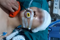 Bắt nhóm đối tượng đánh nam sinh chấn thương sọ não trước cửa nhà