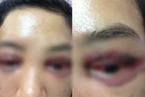 Cắt mí mắt hỏng: Người bảo lãnh cho nạn nhân bị nhắn tin đe dọa