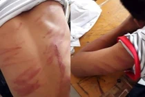 Nghi án học sinh lớp 8 ở Hà Tĩnh bị bố ruột đánh đập dã man