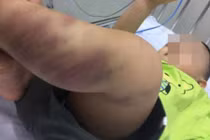 Hãi hùng loạt vụ bạo hành trẻ em tàn bạo giữa Thủ đô