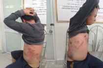 Hà Nội: Nghi vấn phản đối thu phí BOT, tài xế bị đánh gãy xương sườn?