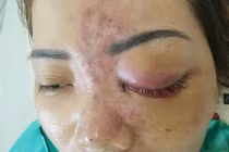 TPHCM: Kinh hãi cô gái mù mắt sau 5 phút tiêm filler ở spa