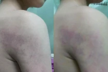 Kỷ luật cô giáo đánh học sinh thâm tím người ở Hà Nội 