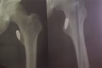 Vận động viên Pencak - Silat bị bắn 