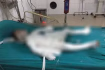 Bé trai bị bố dượng tẩm xăng đốt bỏng 98% đã qua đời