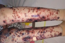 Bé gái Việt mắc bệnh cực hiếm kèm loét hoại tử và sốt cao