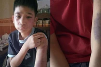 Bố đẻ mẹ kế dùng gậy gỗ đánh con trai 14 tuổi bầm tím khắp người