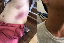 Người đàn ông bầm tím khắp người sau khi bị tạm giữ ở Phú Quốc
