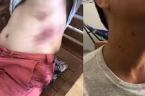 Người đàn ông bầm tím khắp người sau khi bị tạm giữ ở Phú Quốc