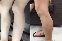 HN: Học sinh tiểu học bị cô giáo dùng thước đánh tím chân