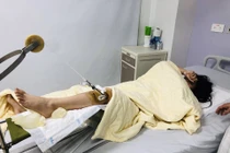 Đi làm thêm, nữ sinh bị ô tô đâm gãy chân, chấn thương sọ não