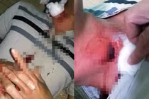 Mổ lấy dị vật nghi là “đạn lạc” chui tọt vào cổ thanh niên