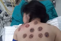 Kinh hoàng lưng nhiễm trùng, chảy máu lẫn mủ vì đi giác hơi