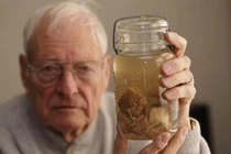 Sự thật về bộ não thiên tài bị đánh cắp của Einstein