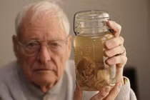 Sự thật về bộ não thiên tài bị đánh cắp của Einstein