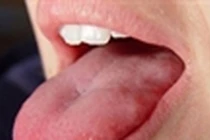 Sự thực xót xa chiếc lưỡi dài “quái vật” của cậu bé tội nghiệp