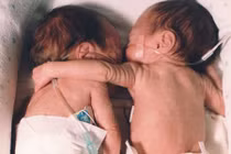 Đặt bé sơ sinh hấp hối nằm cạnh chị sinh đôi... kết quả chấn động